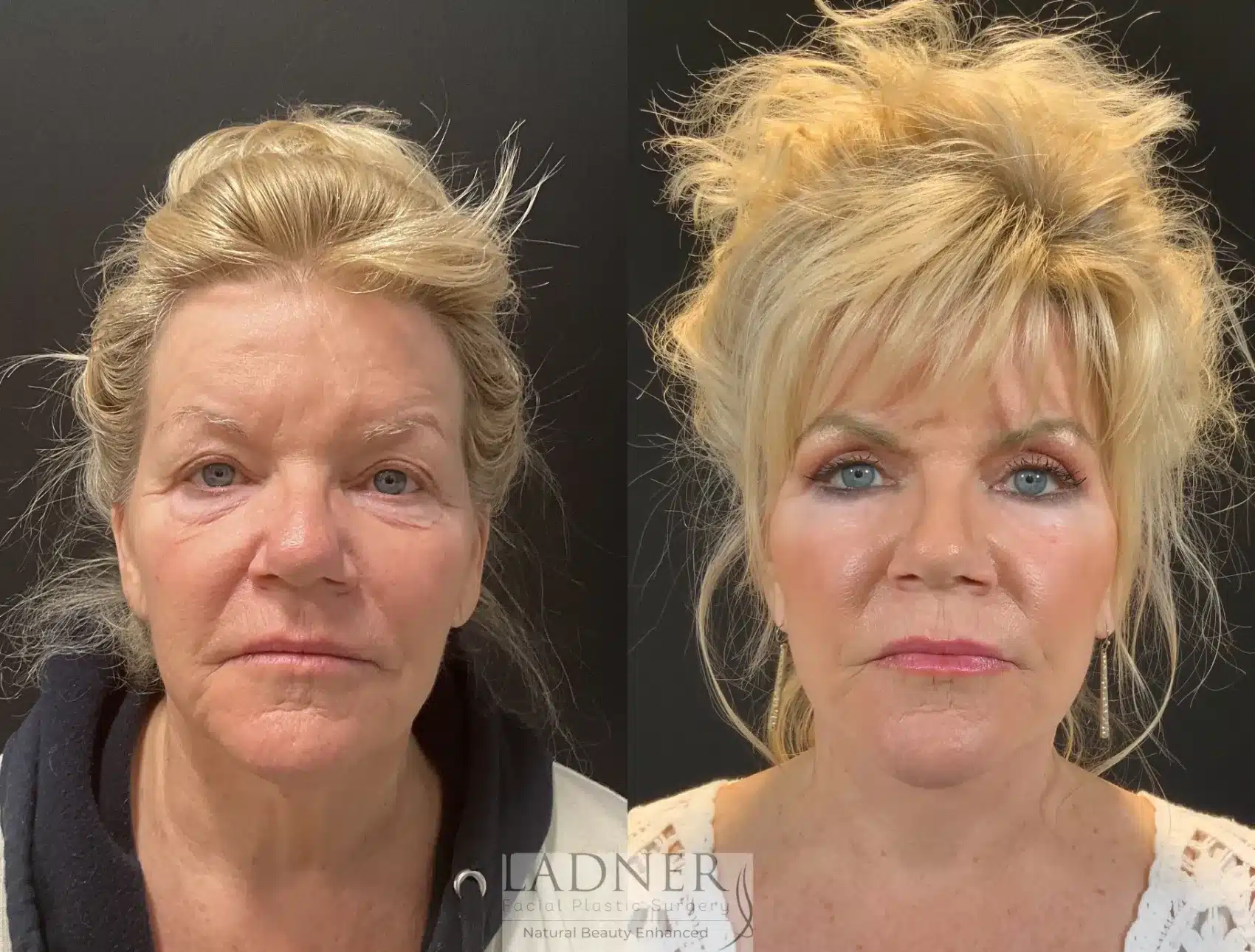 Deep Plane Facelift before and after - after