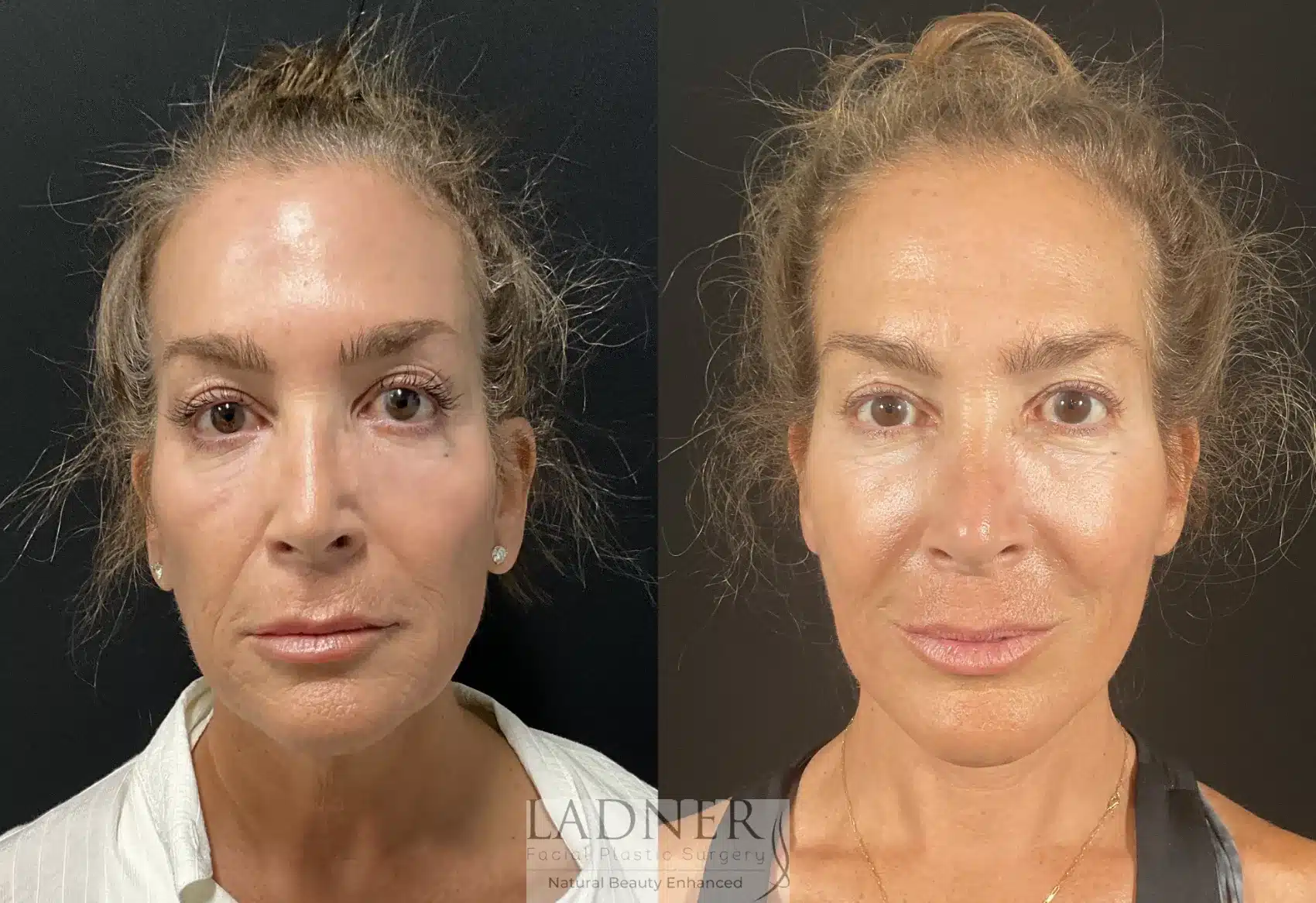 Deep Plane Facelift before and after - before
