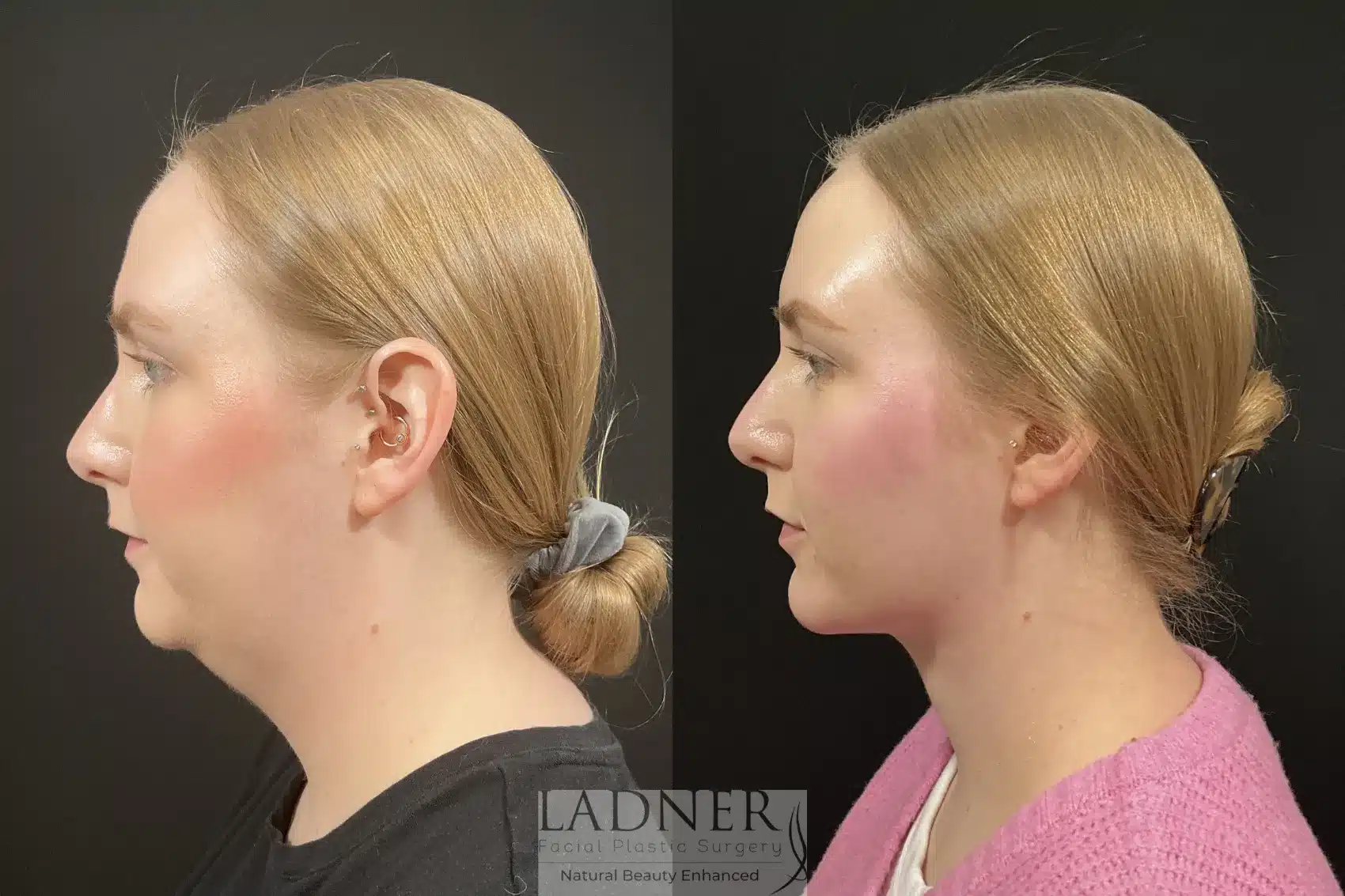 Minimally Invasive Neck Tightening & Chin Augmentation before and after - after