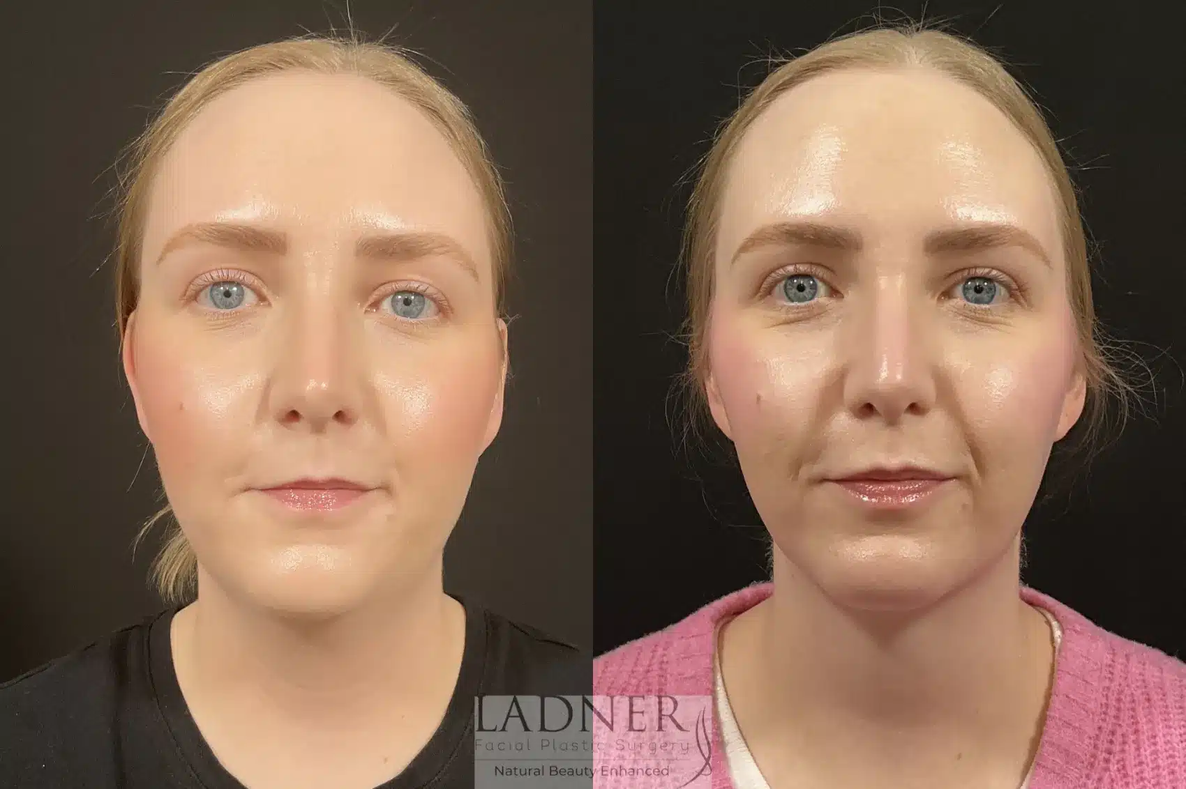 Minimally Invasive Neck Tightening & Chin Augmentation before and after - before