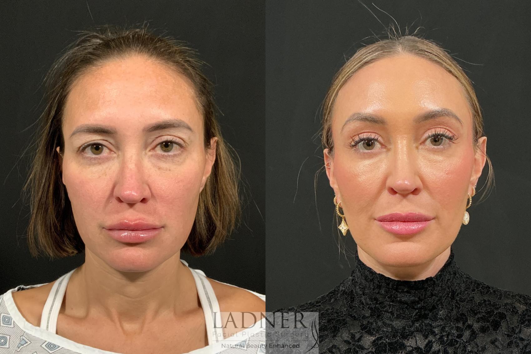 Browlift before and after - after