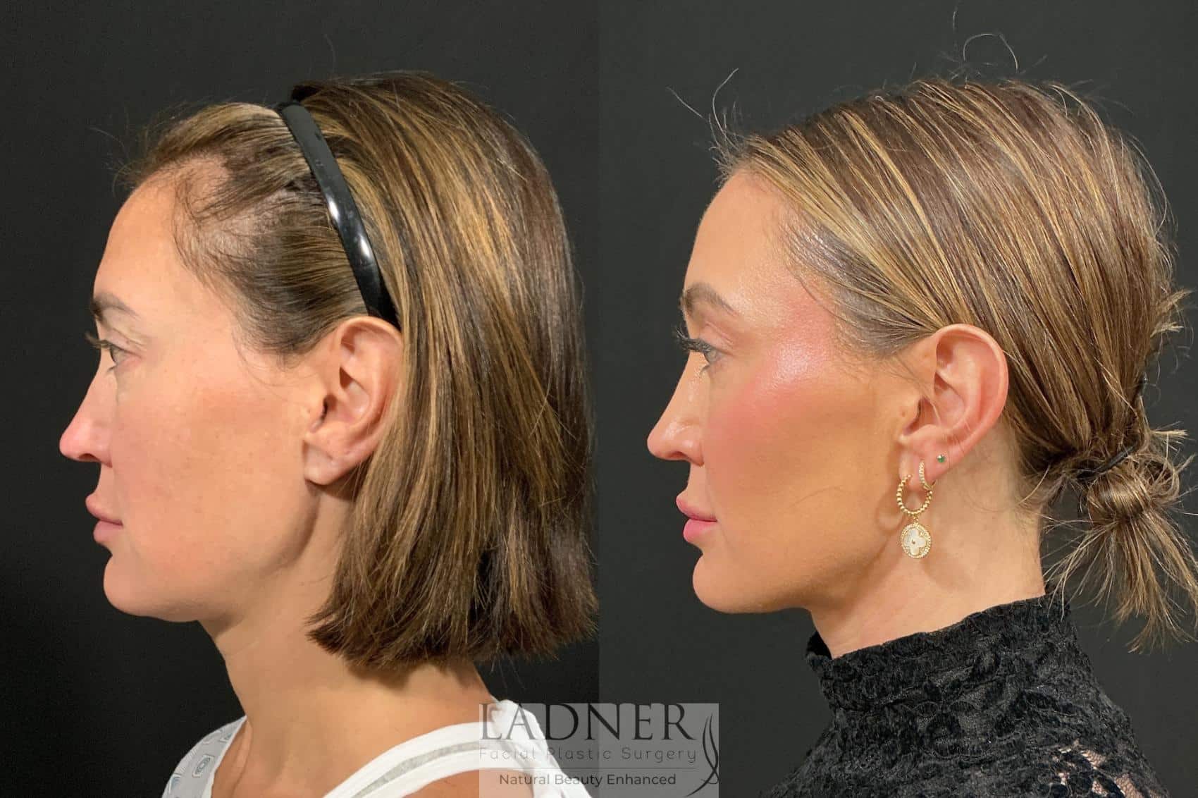 Browlift before and after - before