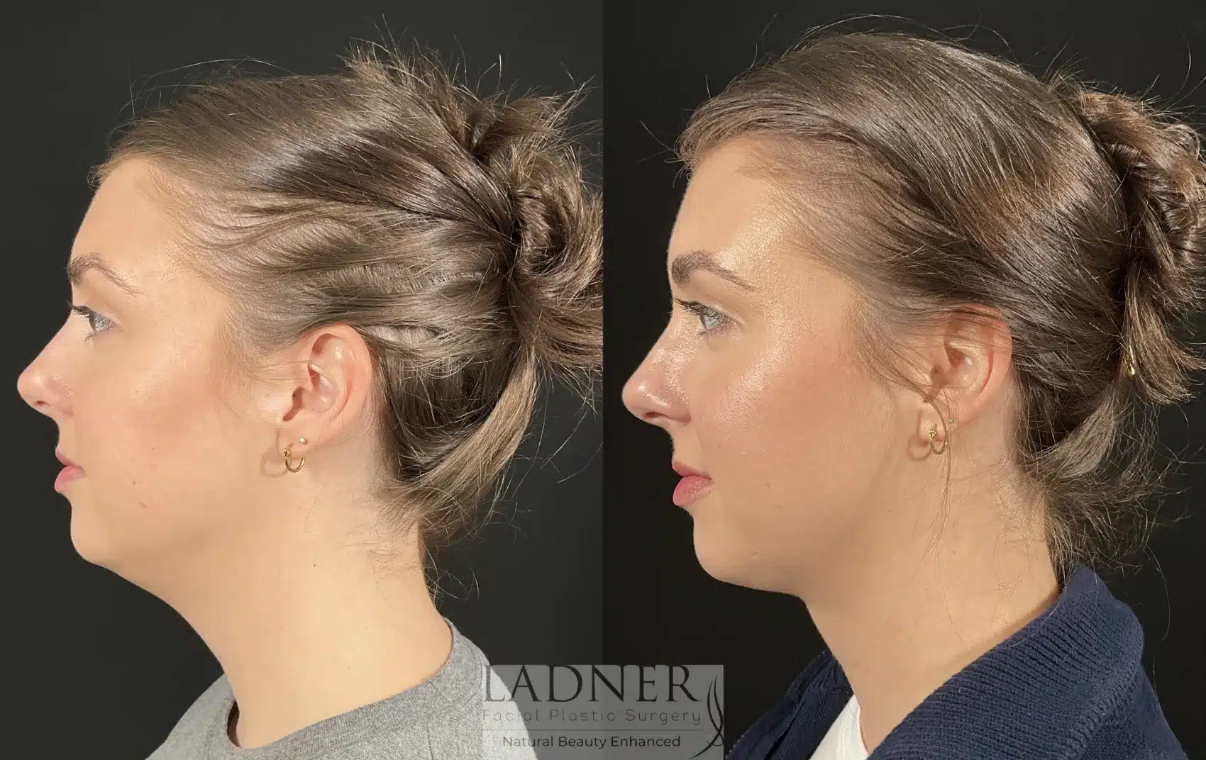 Submental Liposuction before and after - after