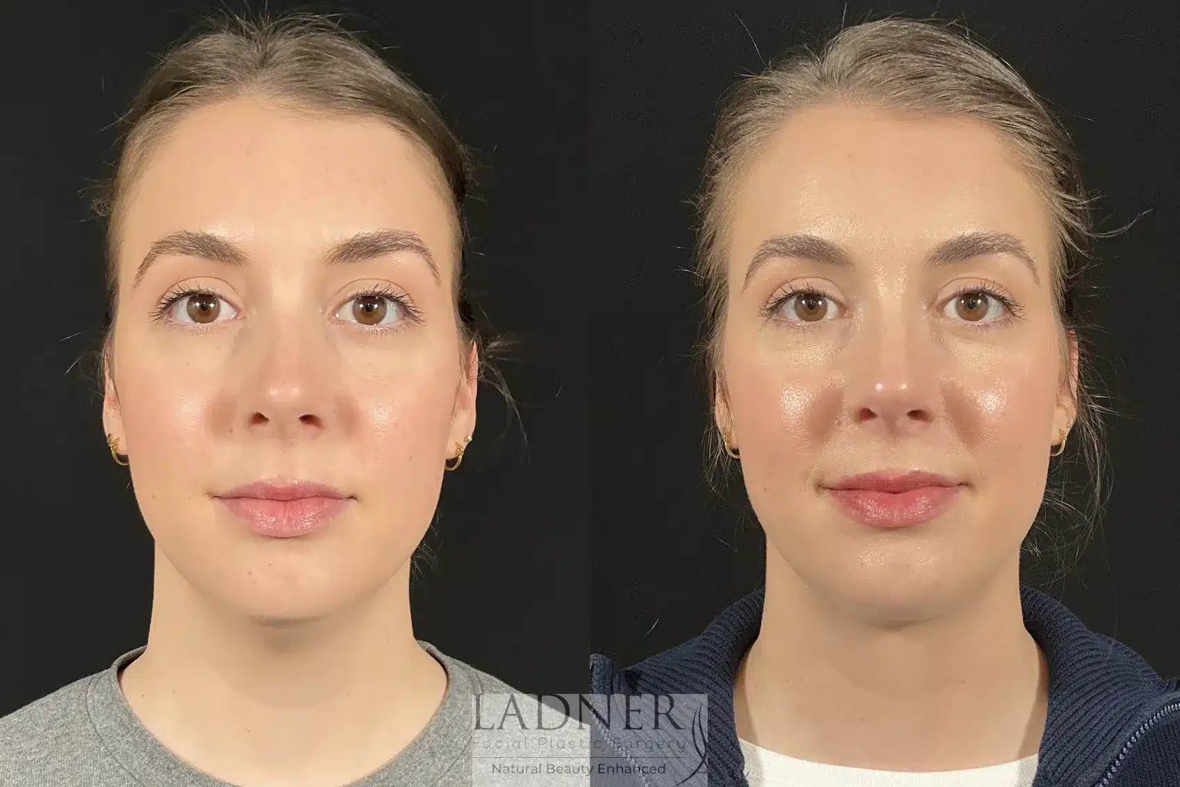 Submental Liposuction before and after - before