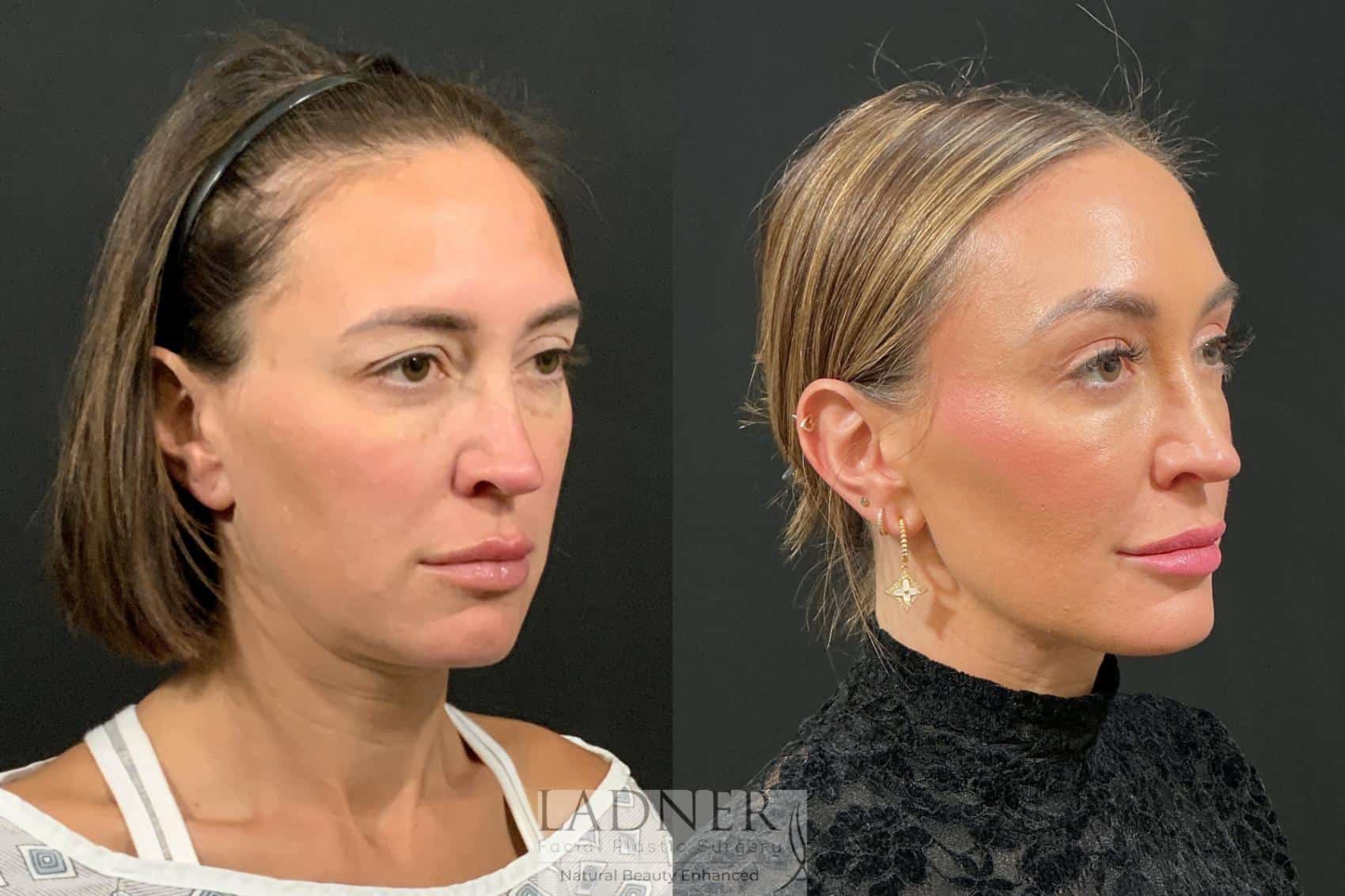Brow Lift / Forehead Lift before and after - after