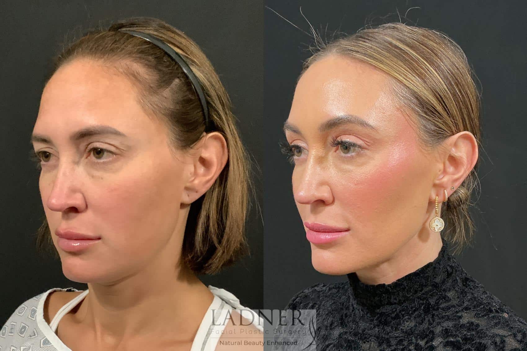 Brow Lift / Forehead Lift before and after - before