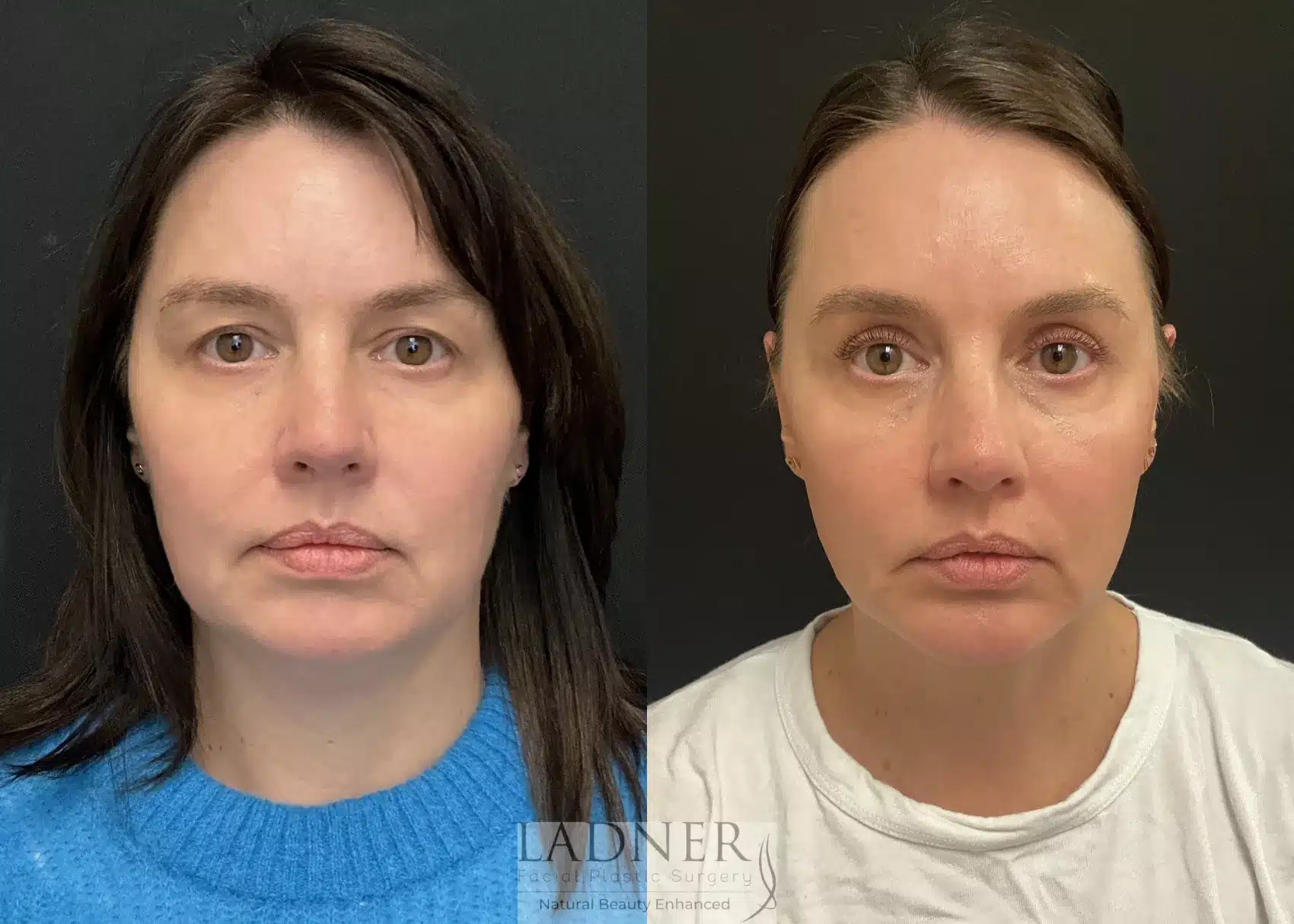 Minimally Invasive Neck Tightening before and after - after