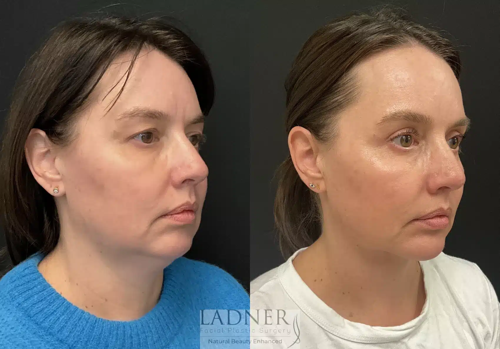 Minimally Invasive Neck Tightening before and after - before