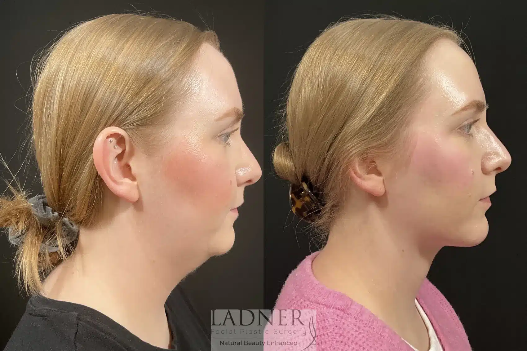 Minimally Invasive Neck Tightening before and after - after