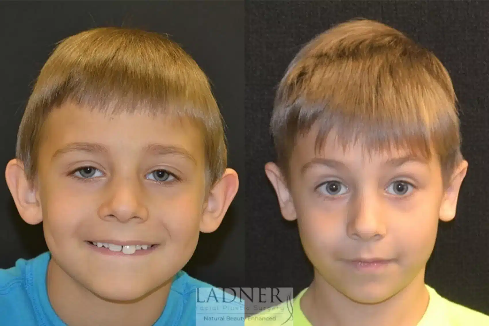 Ear Surgeries before and after - after
