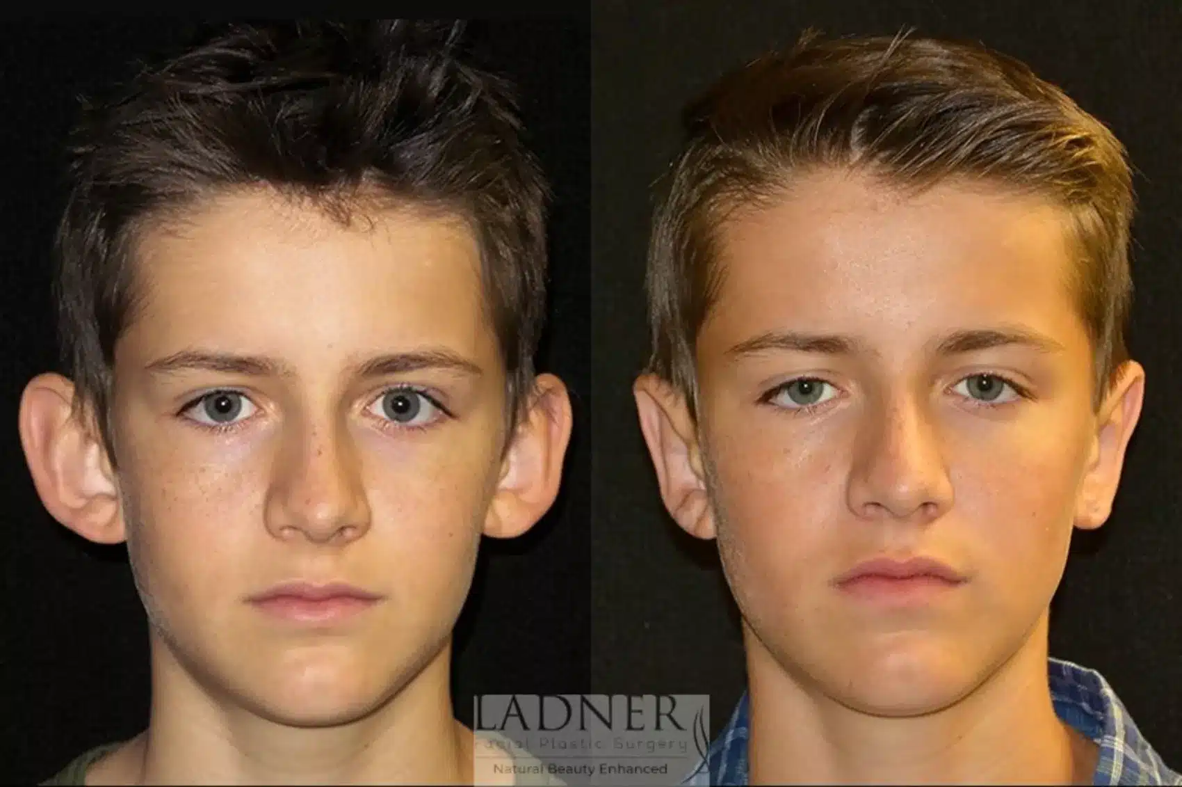 Ear Surgeries before and after - before