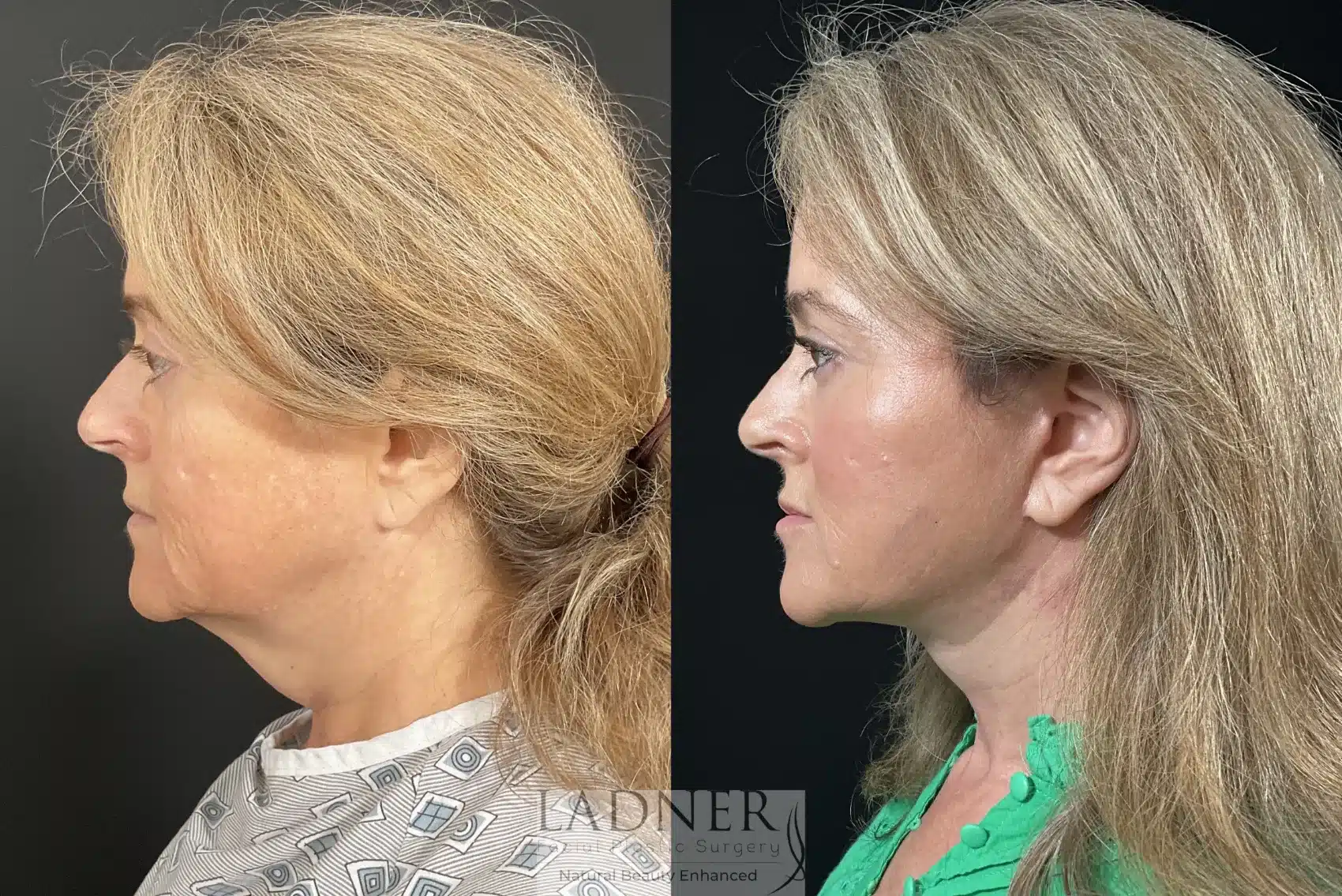 Deep Plane Facelift/Neck Lift, Revision Upper Blepharoplasty, and Brow Lift/Forehead Lift before and after - after