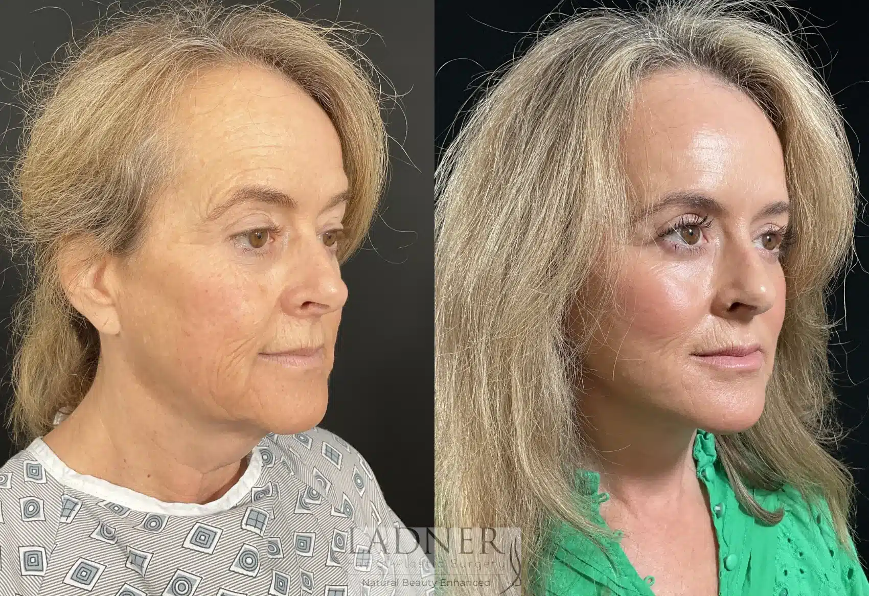 Deep Plane Facelift/Neck Lift, Revision Upper Blepharoplasty, and Brow Lift/Forehead Lift before and after - before