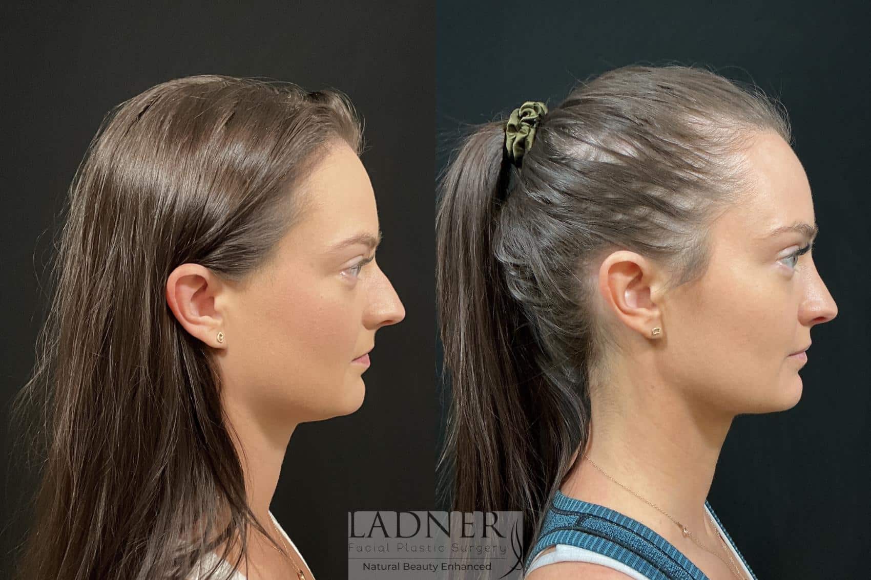 Rhinoplasty before and after - after