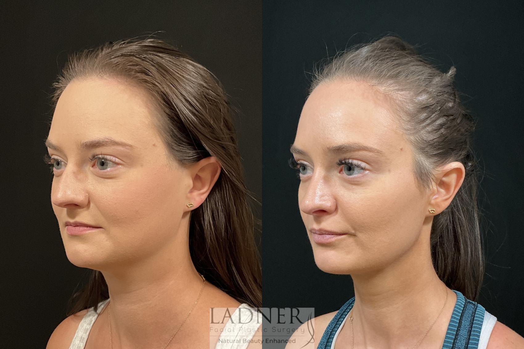 Rhinoplasty before and after - before