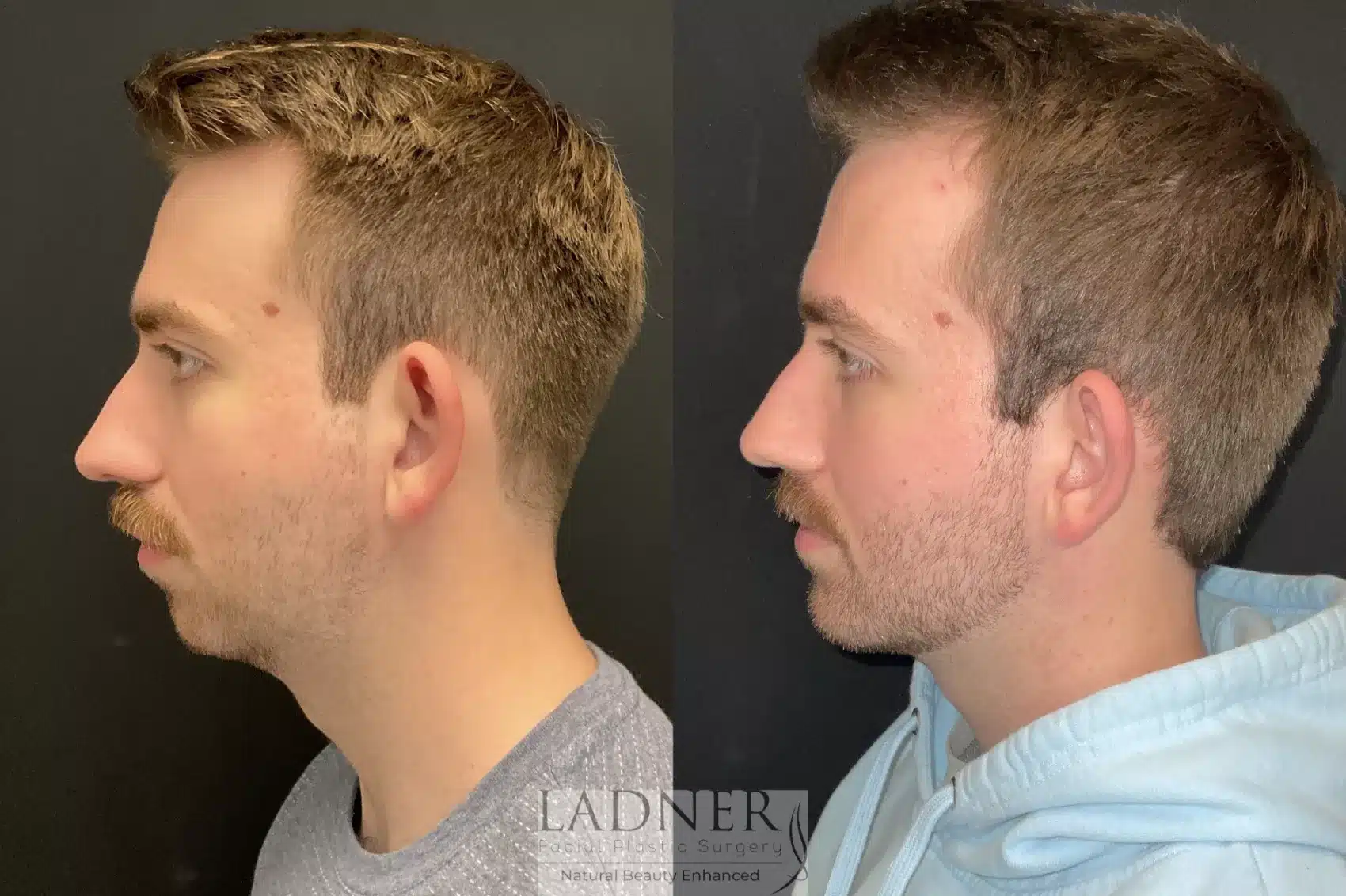 Chin Augmentation before and after - after