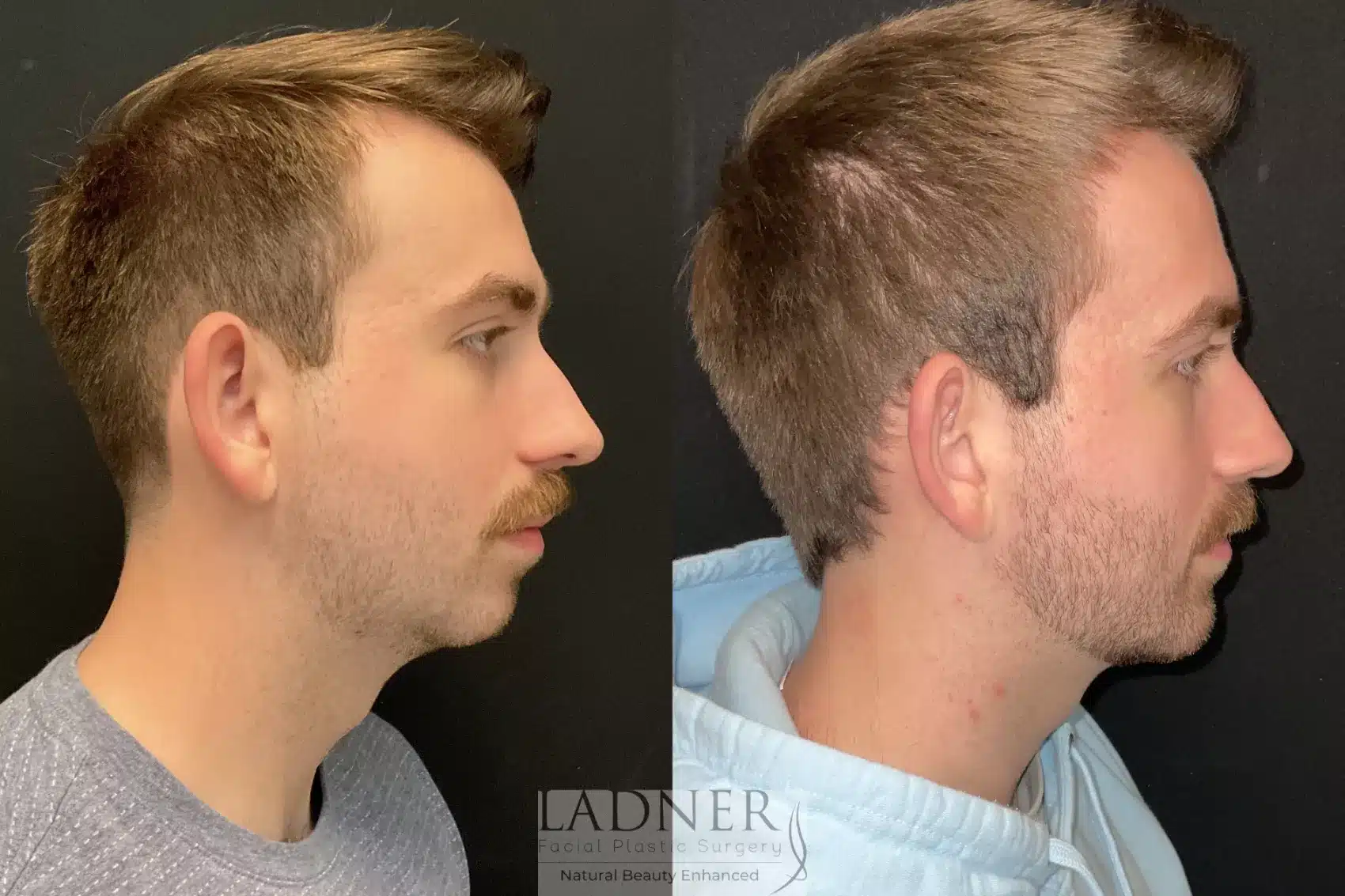 Chin Augmentation before and after - before