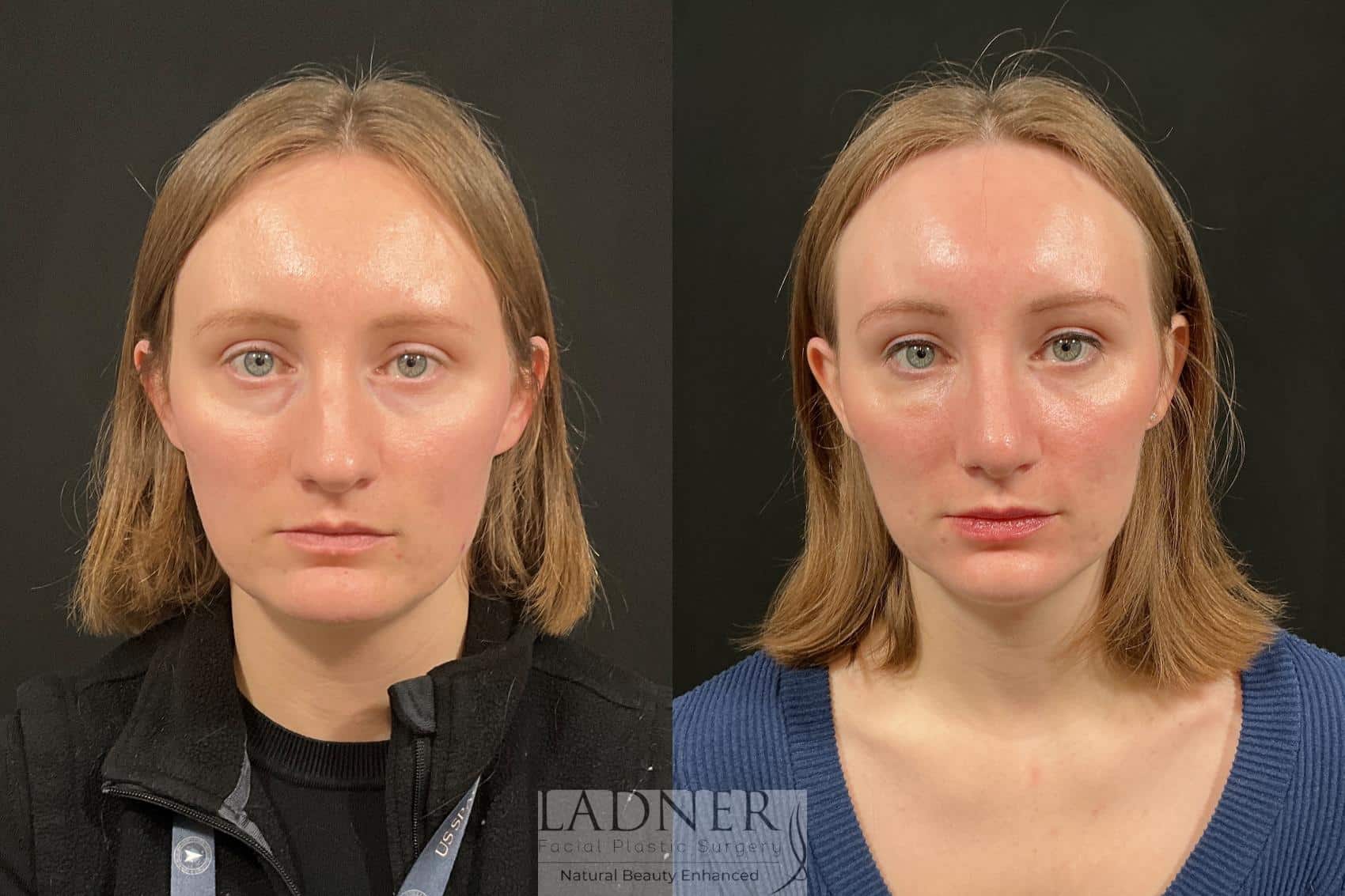 Rhinoplasty before and after - after