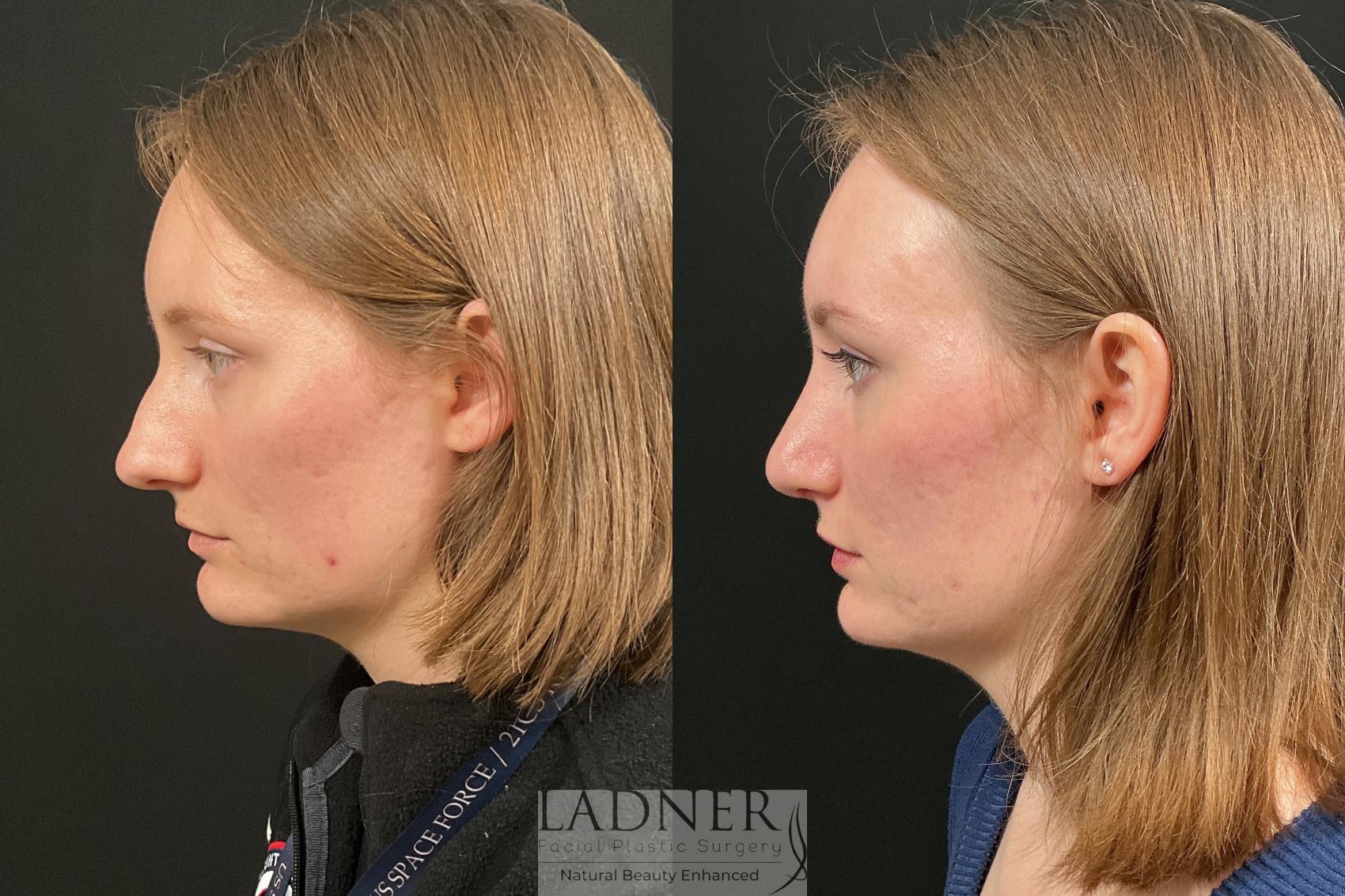 Rhinoplasty before and after - before