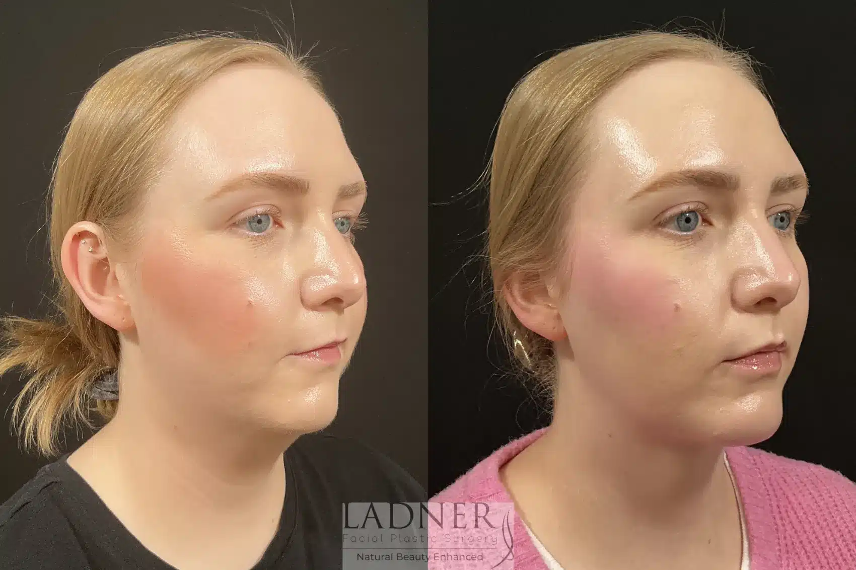 Minimally Invasive Neck Tightening before and after - after