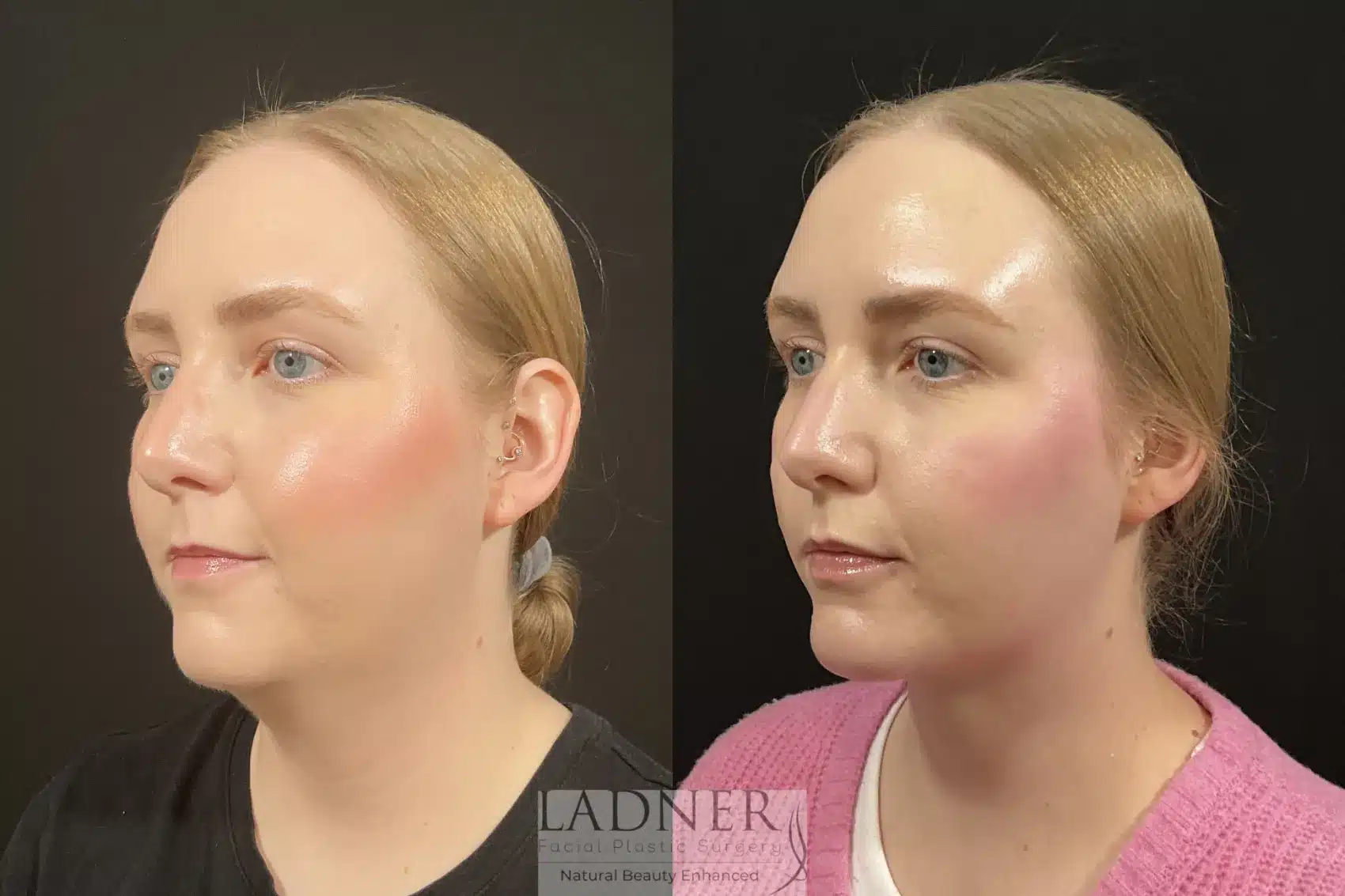 Minimally Invasive Neck Tightening before and after - before
