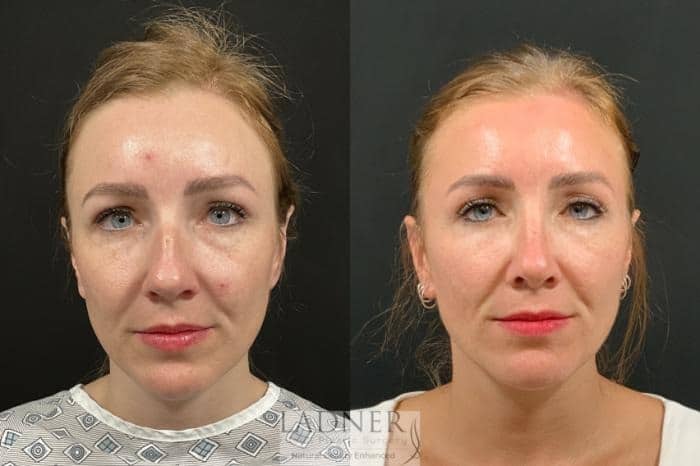 Rhinoplasty before and after - after