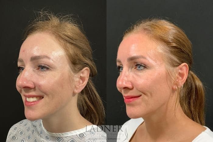 Rhinoplasty before and after - before