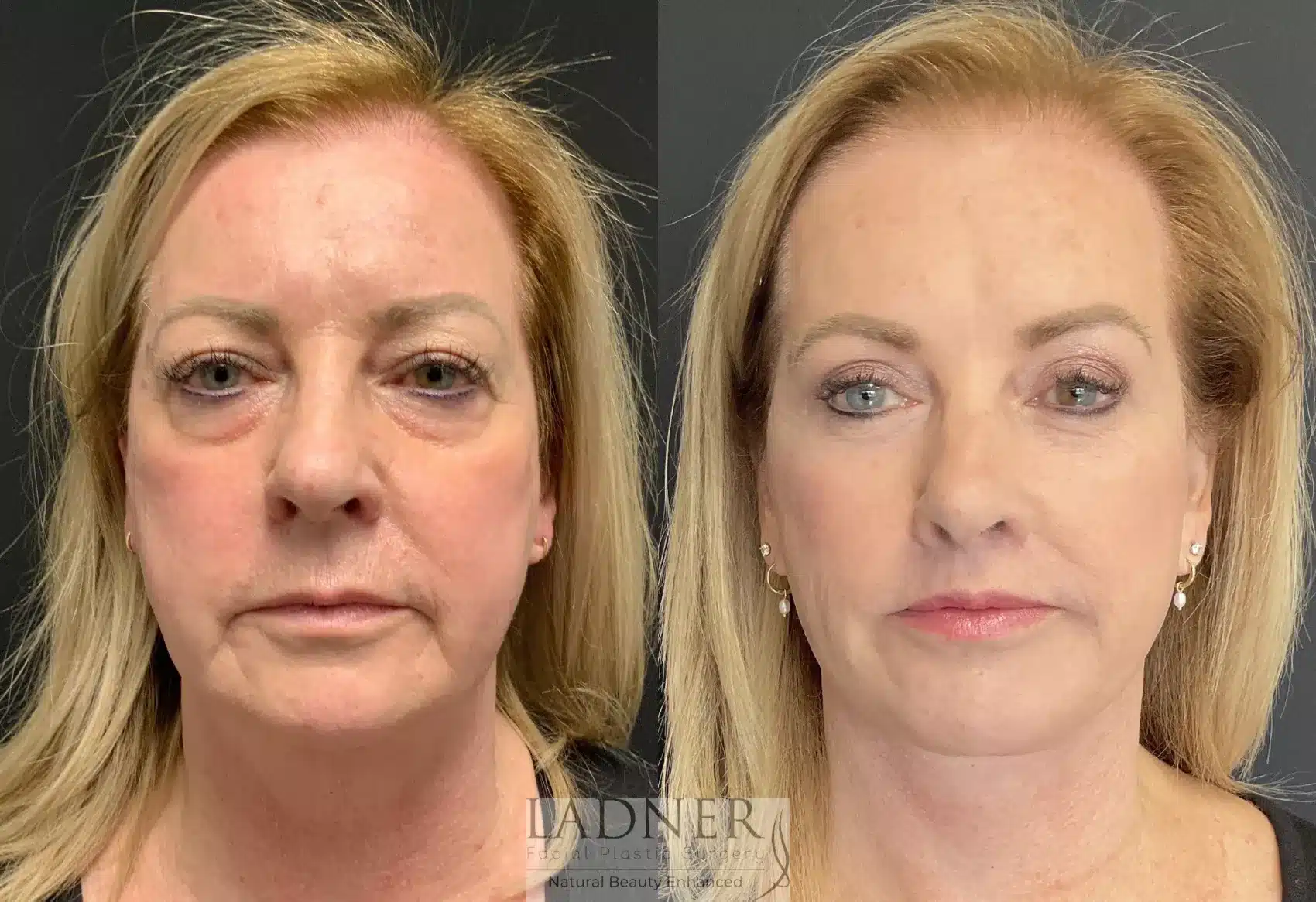 Deep Plane Facelift/Neck Lift before and after - after