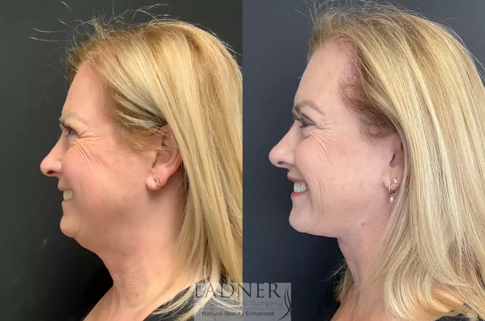 Deep Plane Facelift/Neck Lift before and after - before
