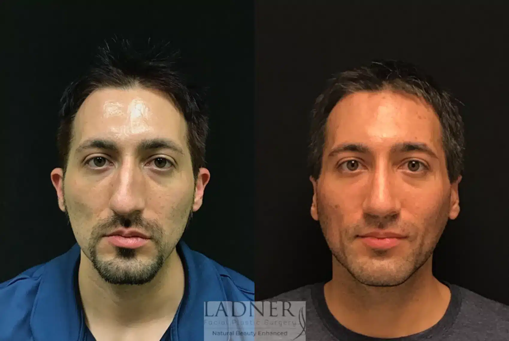 Chin Augmentation before and after - after