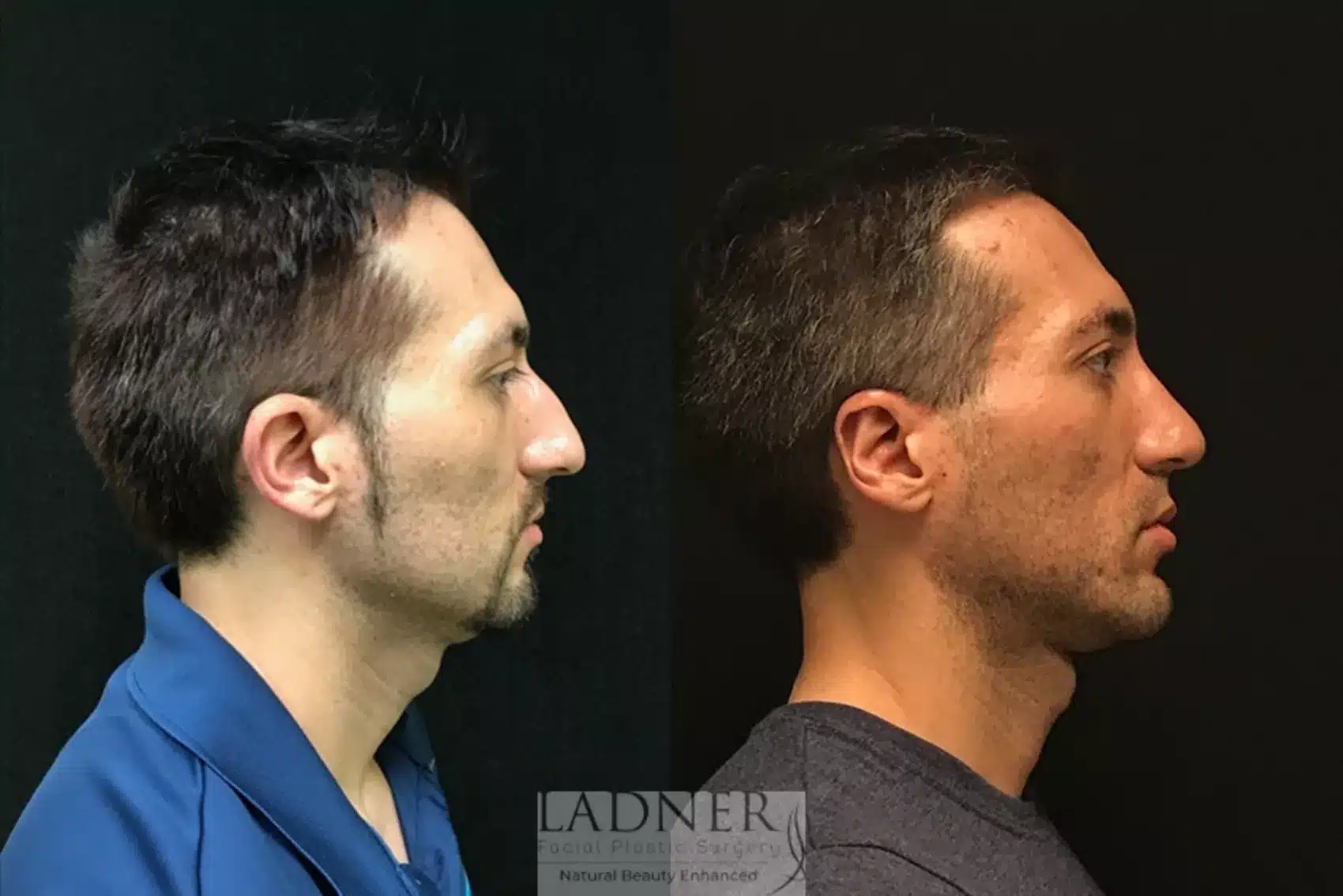 Chin Augmentation before and after - before