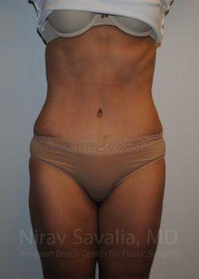 Liposuction before and after - after