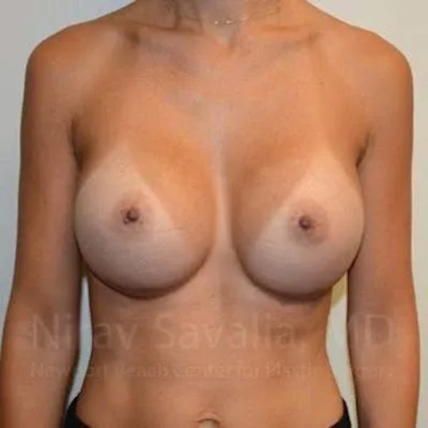 Breast Augmentation before and after - after