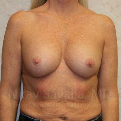 Breast Revision before and after - before