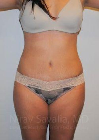 Tummy Tuck before and after - after