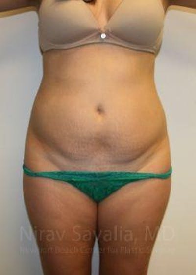 Tummy Tuck before and after - before