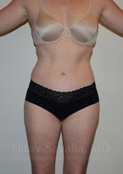 Liposuction before and after - after