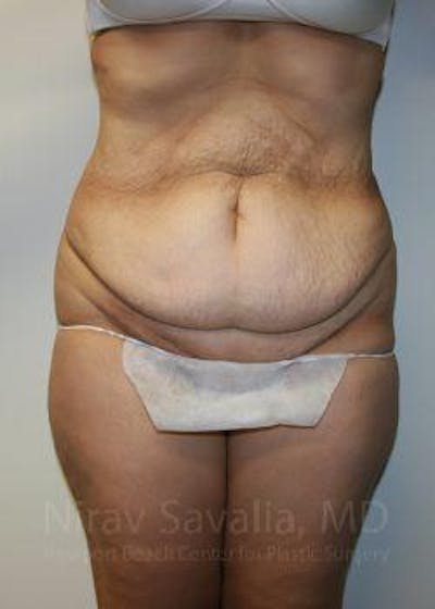 Tummy Tuck before and after - before