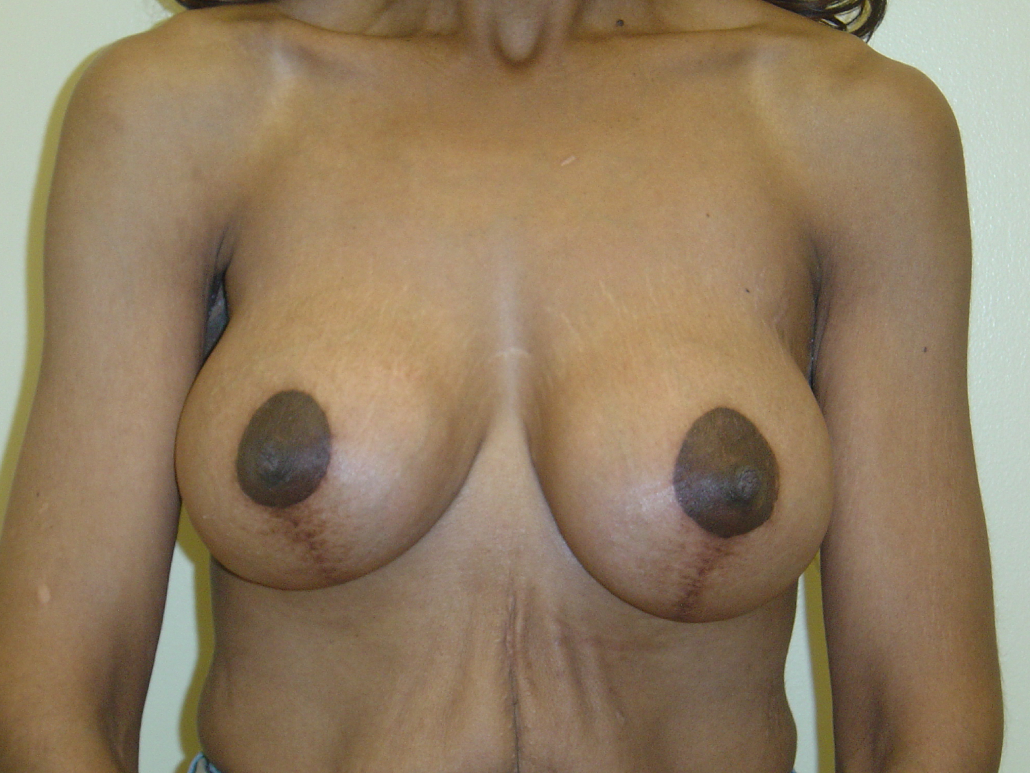 Breast Augmentation and Lift before and after - after