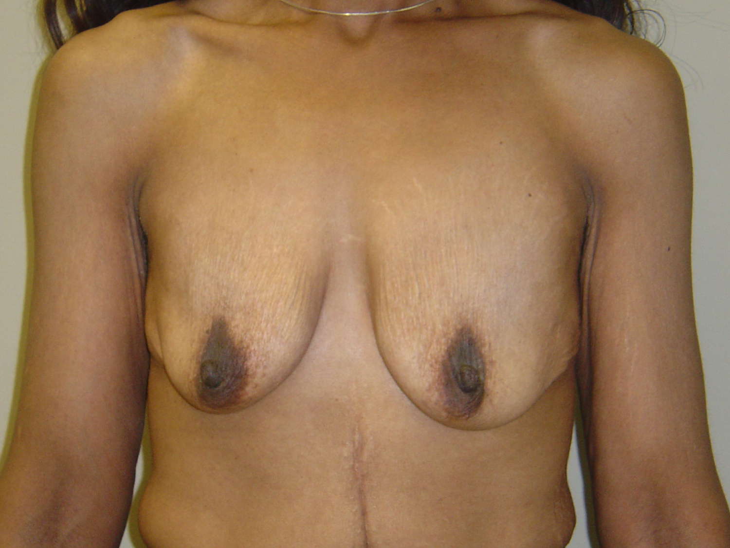Breast Augmentation and Lift before and after - before