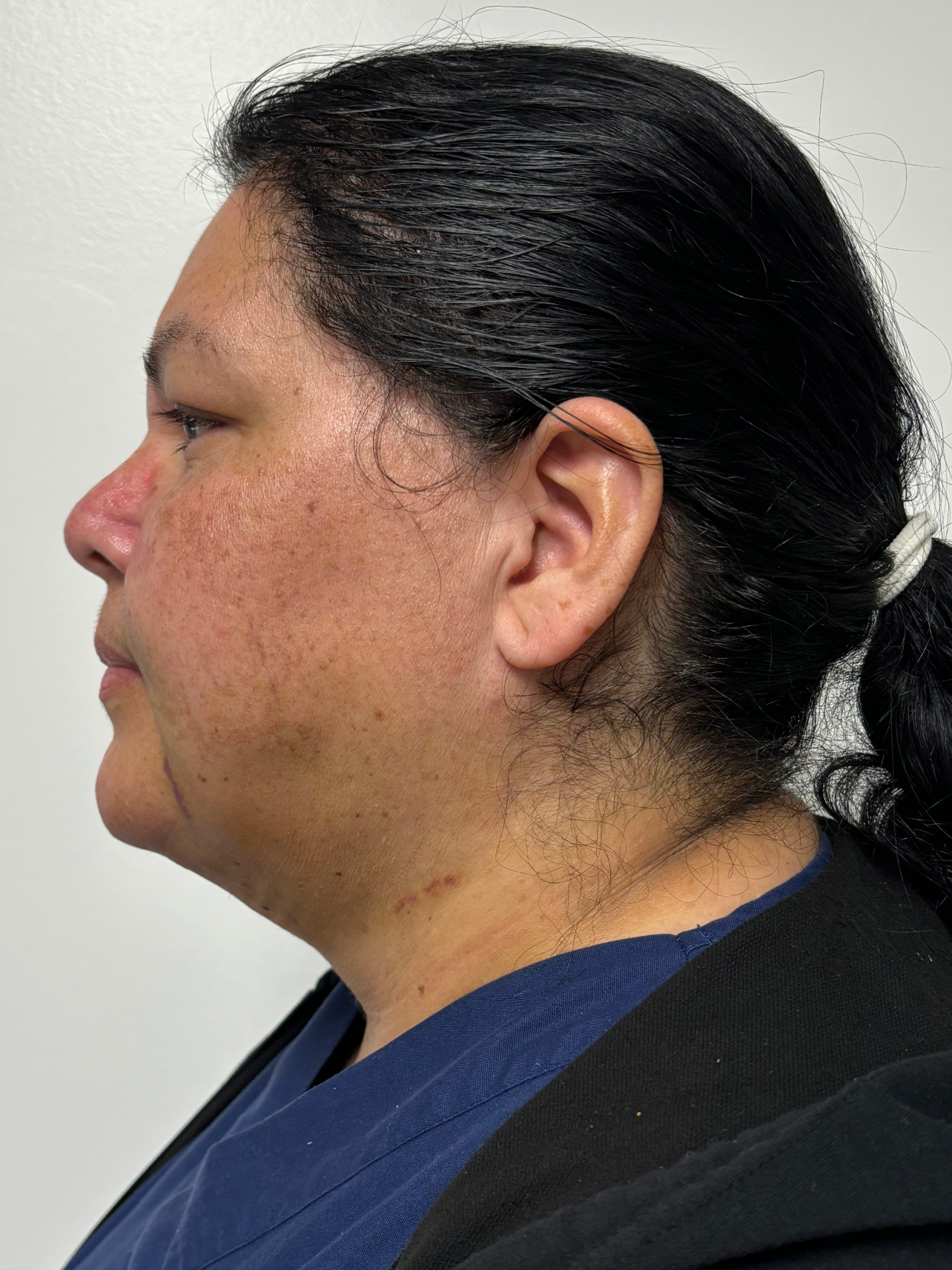 Procedure before and after - after