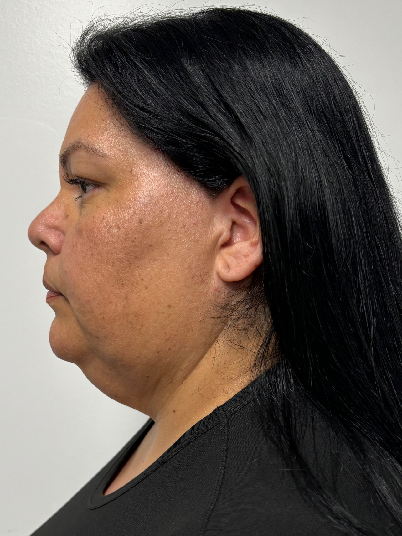 Procedure before and after - before
