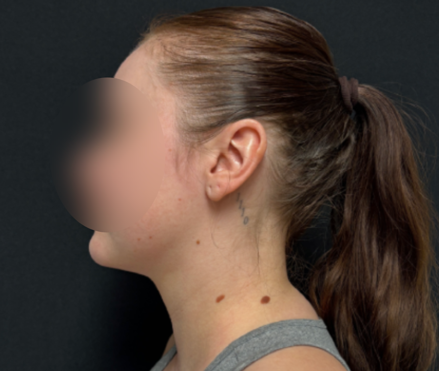 Procedure before and after - after