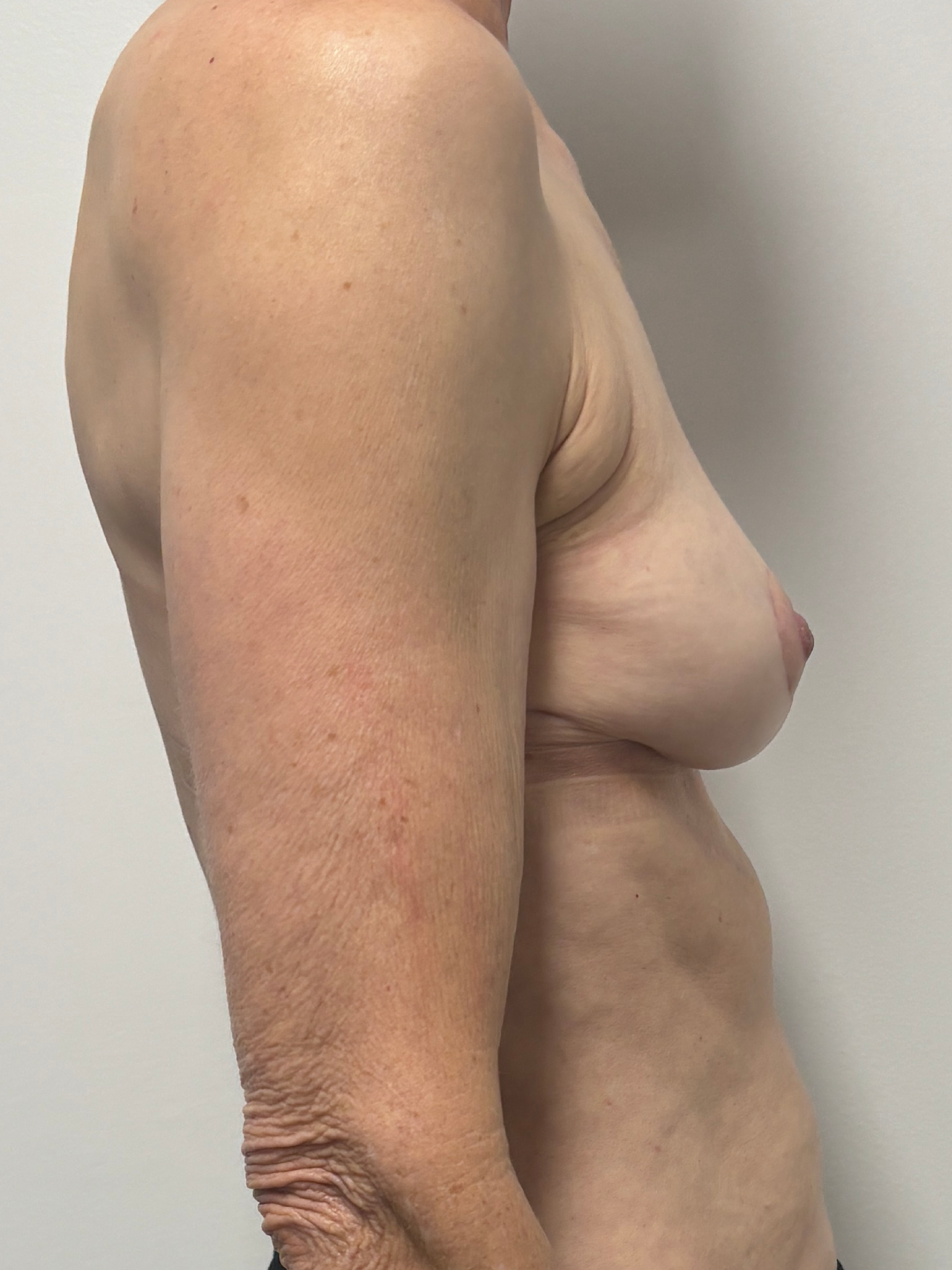 Procedure before and after - after