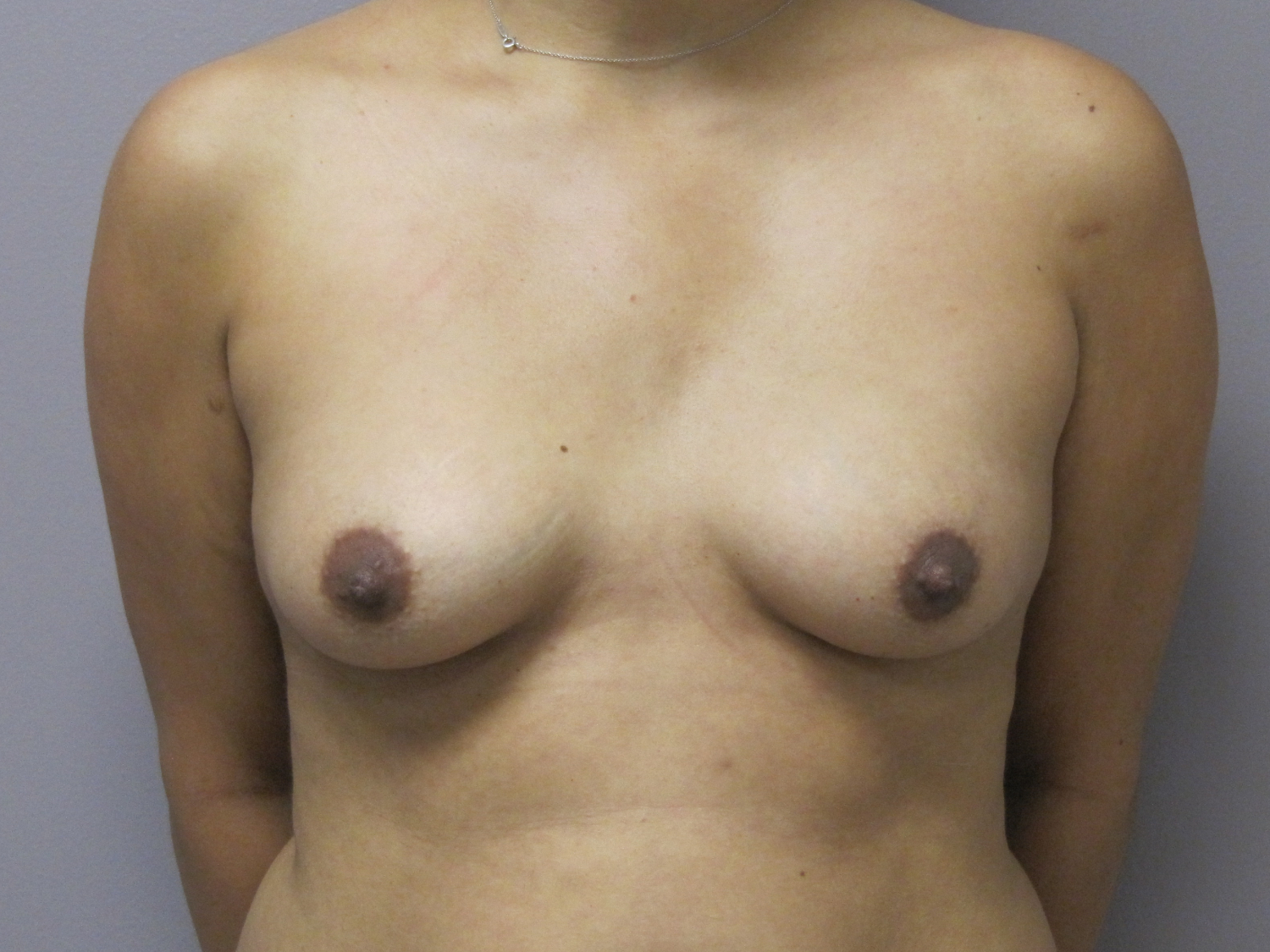 Breast Augmentation and Lift before and after - before