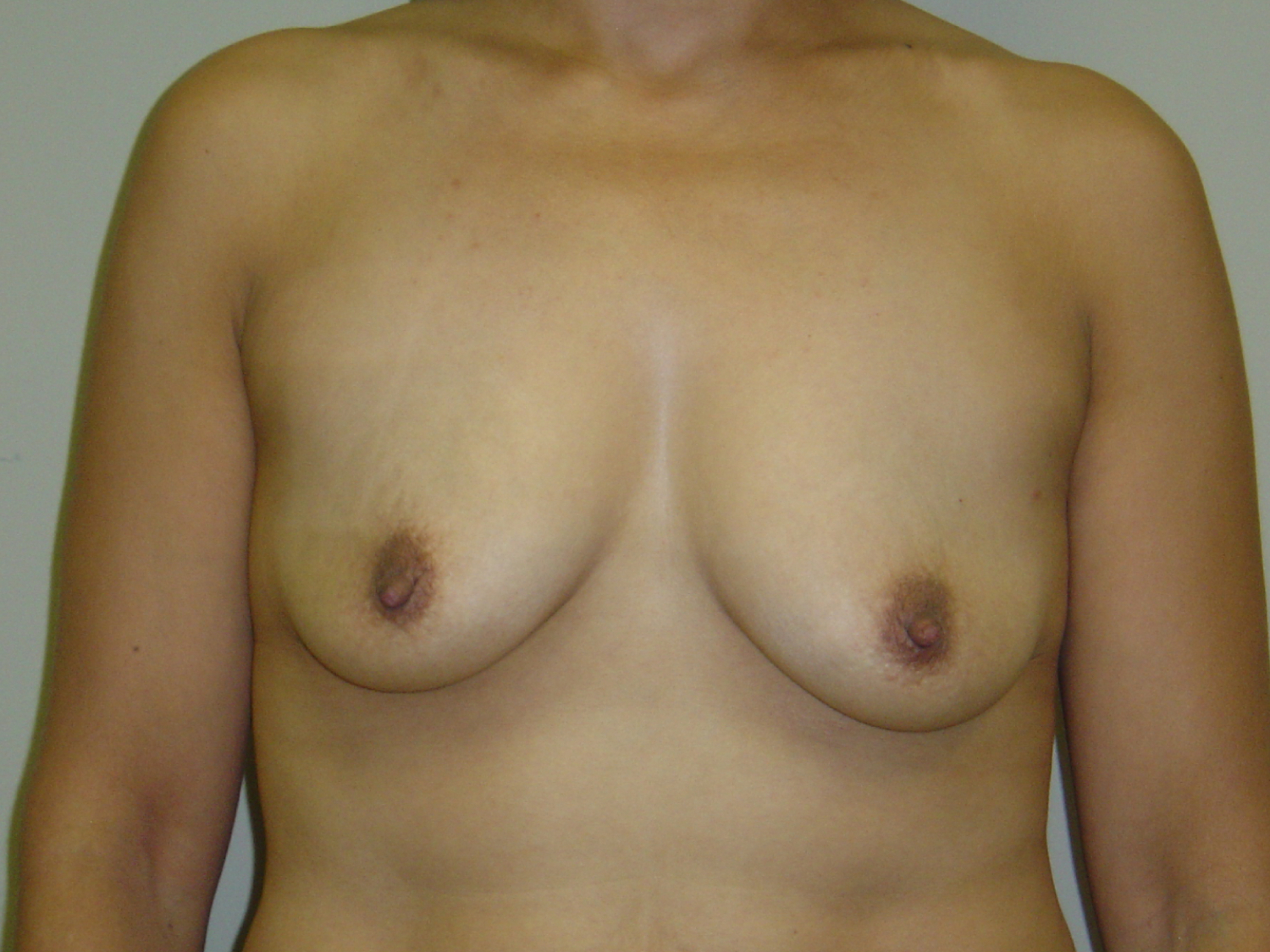 Breast Augmentation and Lift before and after - before