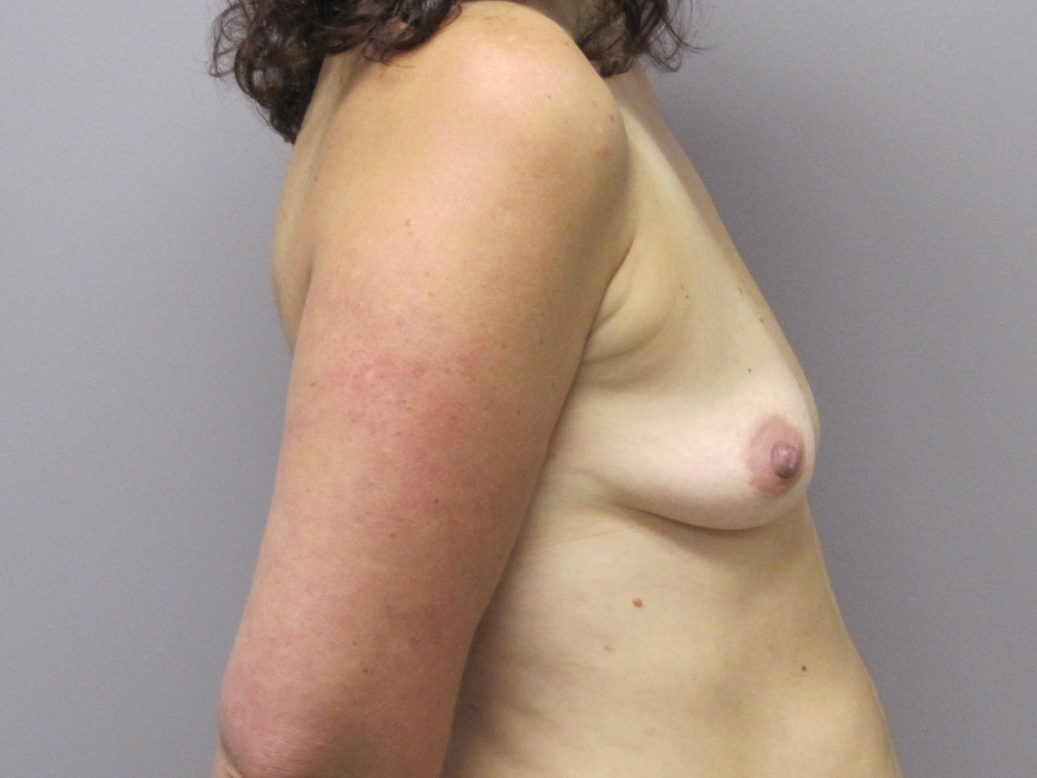 Breast Augmentation and Lift before and after - before