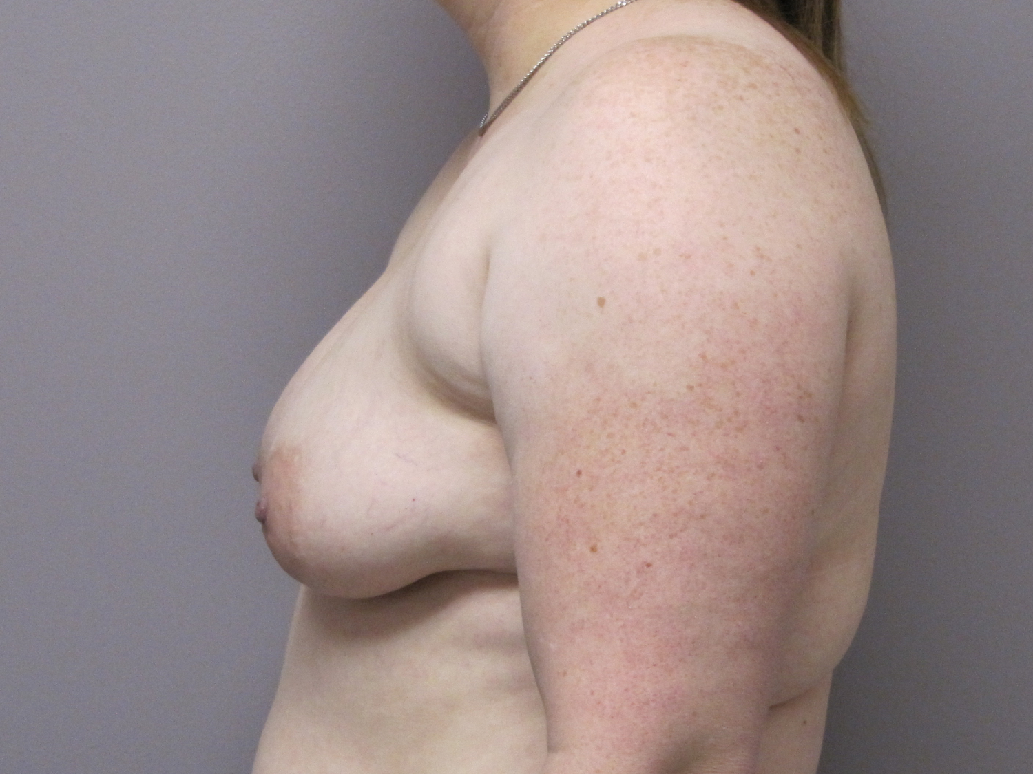 Breast Augmentation and Lift before and after - after