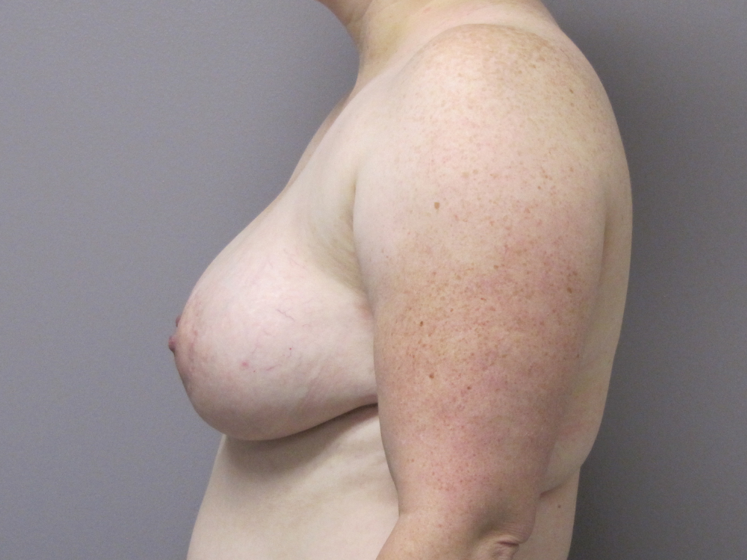 Breast Augmentation and Lift before and after - after