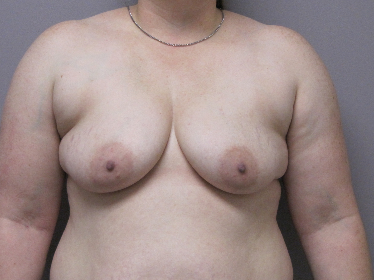 Breast Augmentation and Lift before and after - before